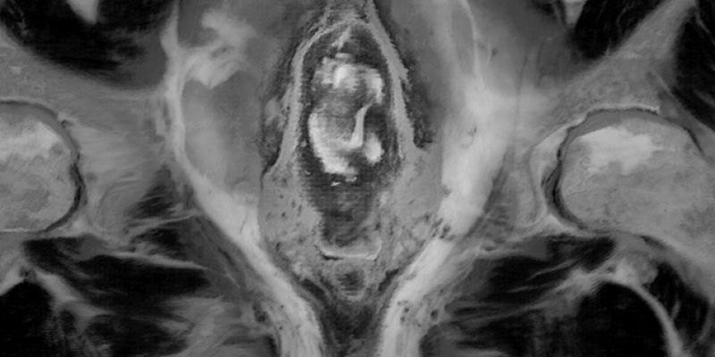 Ninfomaníaca - Versão do Diretor | Nymphomaniac - Director's Cut